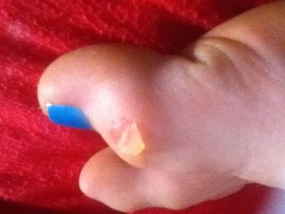 Left toe blister sorry its a semi gross pic